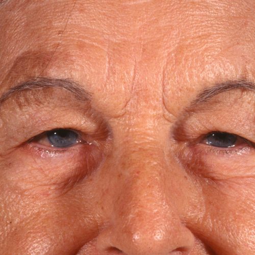 Blepharoplasty 100 Before Photo