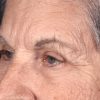 Blepharoplasty 100 After Photo Thumbnail