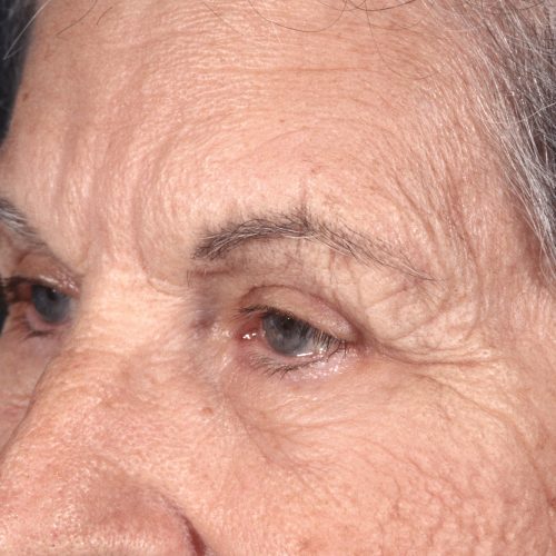 Blepharoplasty 101 After Photo