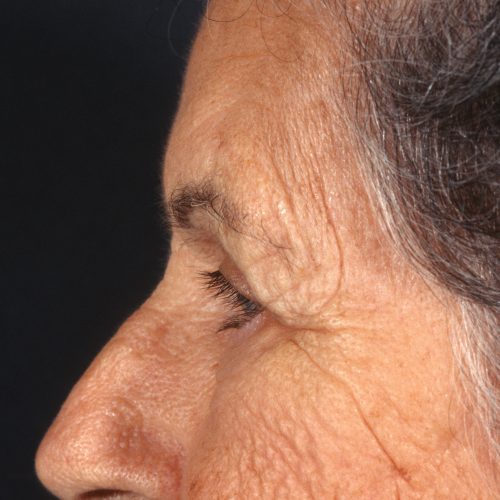 Blepharoplasty 100 After Photo