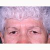 Blepharoplasty 102 Before Photo Thumbnail