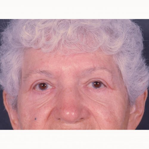 Blepharoplasty 102 After Photo