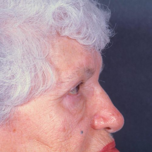 Blepharoplasty 102 After Photo