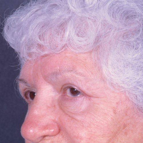 Blepharoplasty 102 After Photo