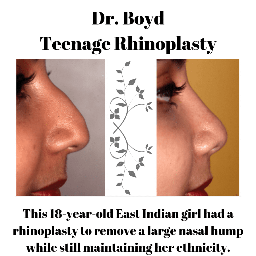 18 year-old girl rhinoplasty before and after