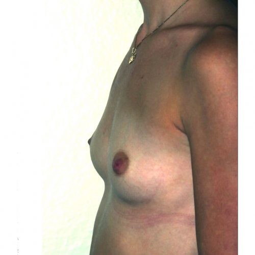 Prepectoral Breast Augmentation Before Photo