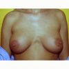 Prepectoral Breast Augmentation 3 After Photo Thumbnail