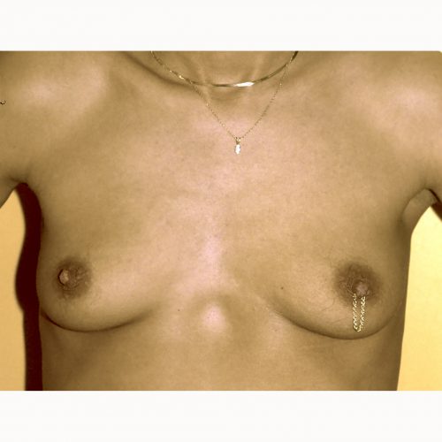 Prepectoral Breast Augmentation 3 Before Photo 