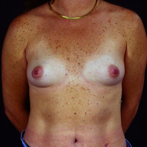 Breast Augmentation 101 Before Photo 