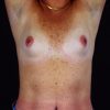 Breast Augmentation 101 Before Photo Thumbnail