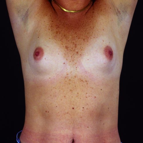 Breast Augmentation 101 Before Photo