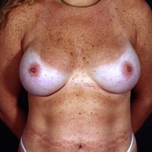 Breast Augmentation 101 After Photo 