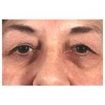 Blepharoplasty 231 Before Photo - 4