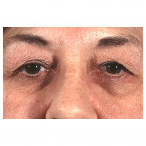 Blepharoplasty 231 Before Photo 