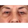 Blepharoplasty 231 After Photo Thumbnail