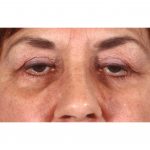 Blepharoplasty 231 After Photo - 4