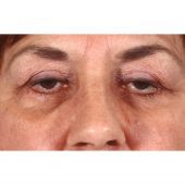 Blepharoplasty 231