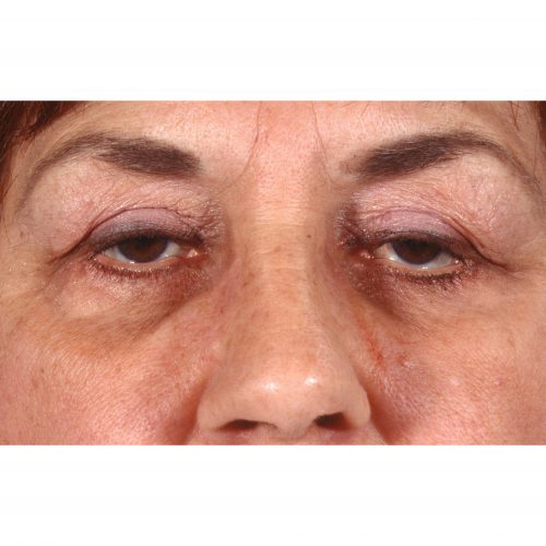 Blepharoplasty 231 After Photo 