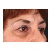 Blepharoplasty 231 After Photo Thumbnail