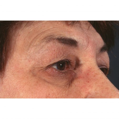 Blepharoplasty 231 Before Photo