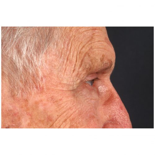 Blepharoplasty 322 After Photo