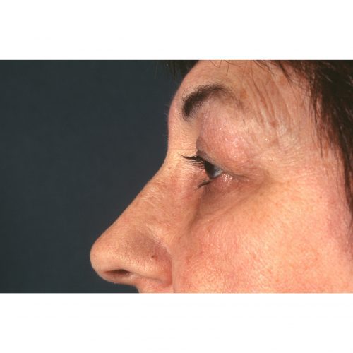 Blepharoplasty 231 Before Photo