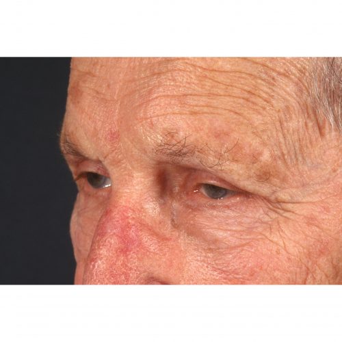 Blepharoplasty 322 After Photo