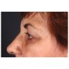 Blepharoplasty 231 After Photo Thumbnail