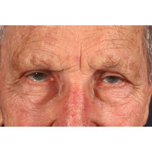 Blepharoplasty 322 After Photo