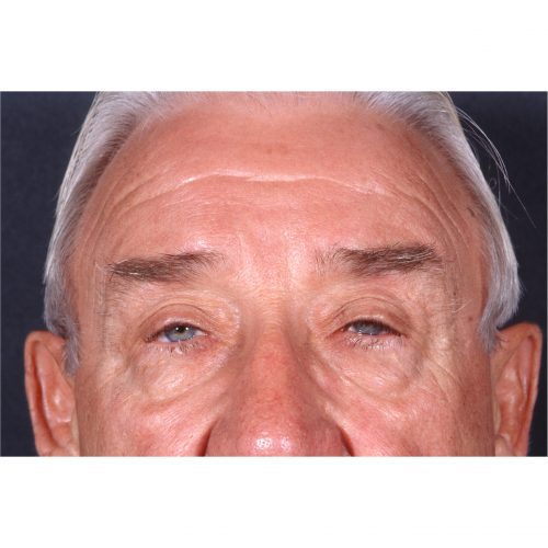 Blepharoplasty/Ptosis Correction 333 Before Photo