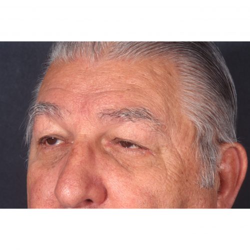 Blepharoplasty/Ptosis correction Before Photo