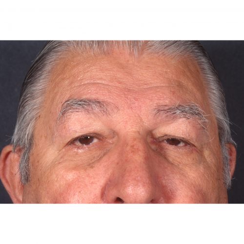 Blepharoplasty/Ptosis correction Before Photo