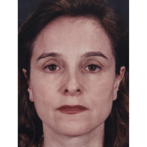 Rhinoplasty 200 After Photo 