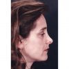 Rhinoplasty 200 After Photo Thumbnail