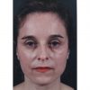 Rhinoplasty 200 Before Photo Thumbnail