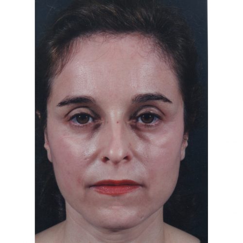 Rhinoplasty 200 Before Photo 