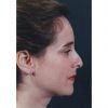 Rhinoplasty 200 Before Photo Thumbnail