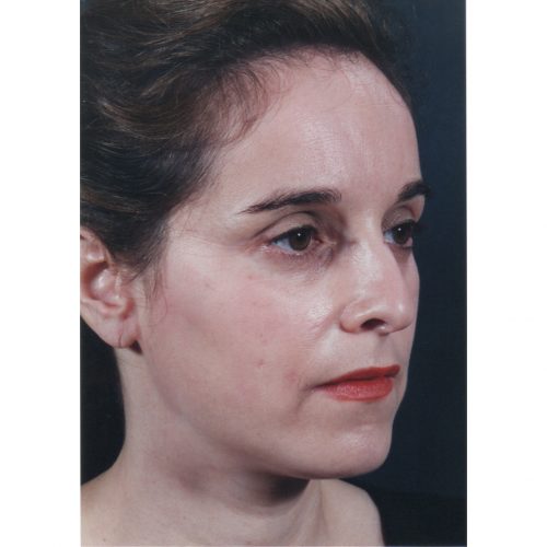 Rhinoplasty 200 Before Photo