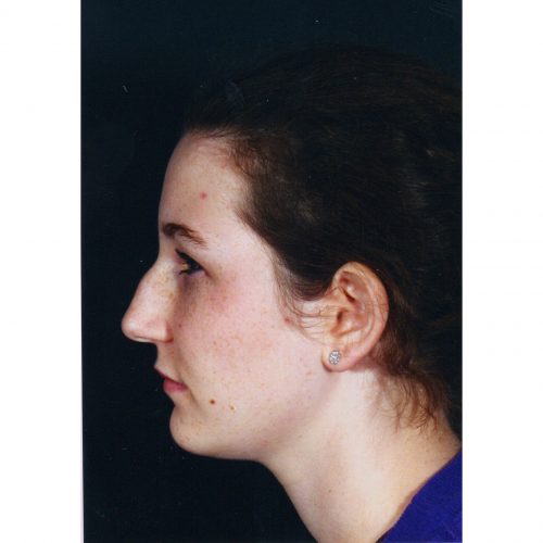 Rhinoplasty 202 Before Photo