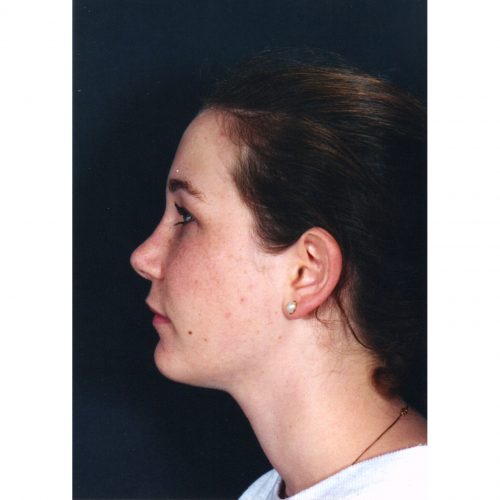 Rhinoplasty 202 After Photo