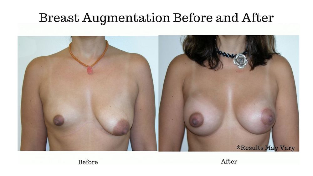 Before and after image showing the results of a woman's breast augmentation performed by Dr. Boyd in Rolling Hills Estates, CA.