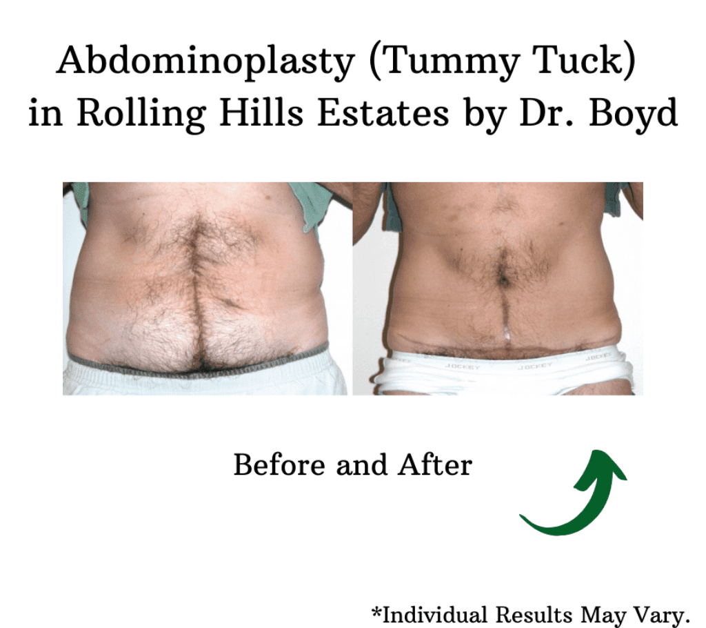 Man before and after abdominoplasty (tummy tuck).
