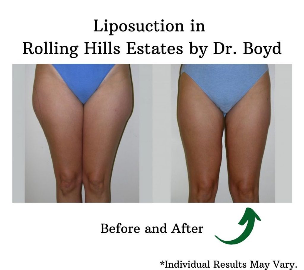 before and after image of liposuction on woman's legs