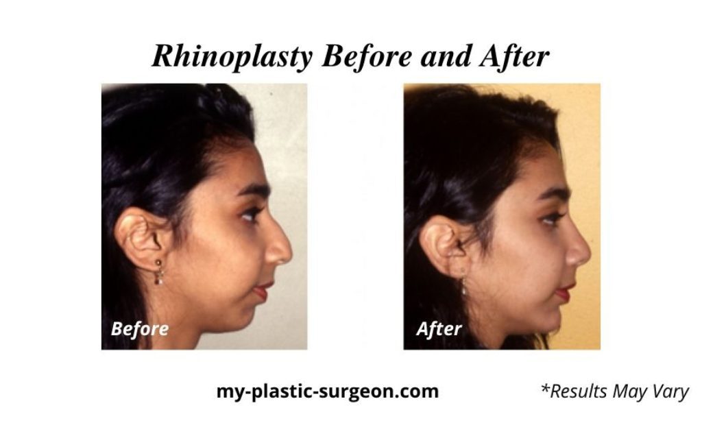 A woman before and after her rhinoplasty surgery with board certified plastic surgeon Brian Boyd MD inc.