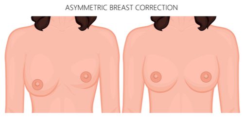 asymmetrical breast correction-img-blog