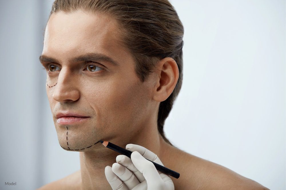 Man with surgical lines on his chin in preparation for plastic surgery.