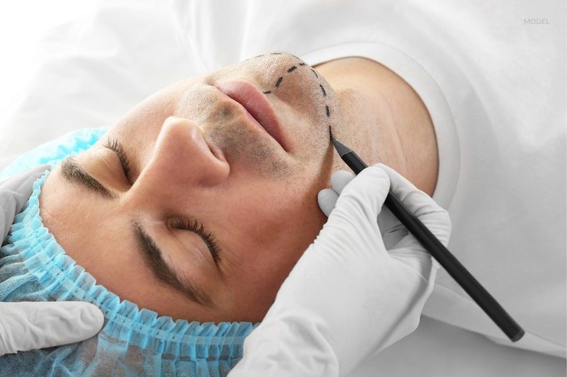 Man preparing for facelift surgery with surgical lines drawn on face.