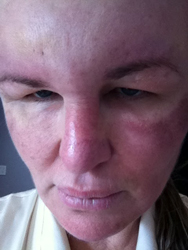 Case - Carol before surgery