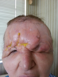 Case - Carol Before surgery