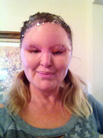 Case - Carol after surgery 2